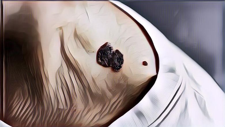 Mengenal Melanoma Jenis Kanker Kulit Paling Berbahaya yang Bisa Memicu&nbsp;Kematian