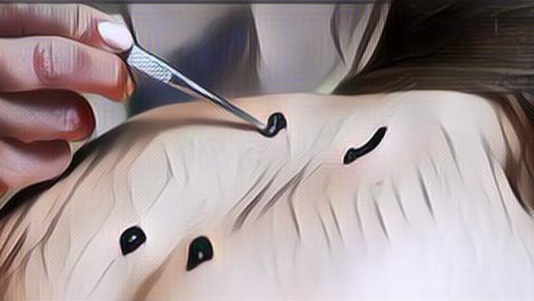 Hebat Banget Ini Dia 5 Manfaat Terapi Lintah untuk&nbsp;Kesehatan