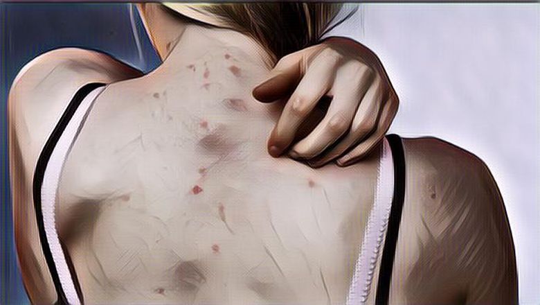 Kesal dengan Kondisi Jerawat Punggung yang Gak Kunjung Hilang Begini Tips Ampuh&nbsp;Mengatasinya