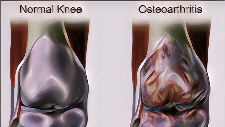 Mengenal Apa Itu Osteoarthritis dan Gejalanya yang Paling&nbsp;Umum